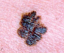 An example of Melanoma - note the dark pigment and uneven edges